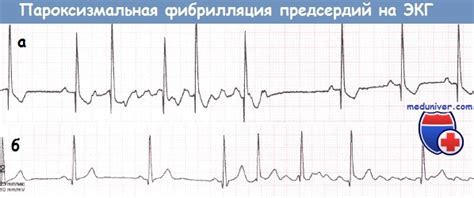 Осложнения от тахисистолической формы фибрилляции предсердий