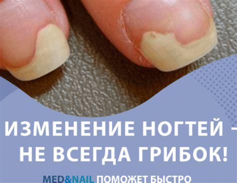 Основные причины гниения ногтей и эффективные методы борьбы с ними