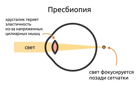 Основные причины и факторы, вызывающие нарушение рефракции глаза у детей