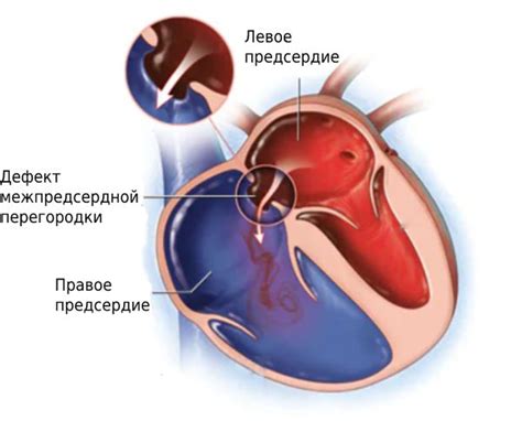 Основные симптомы ВПС ДМПП