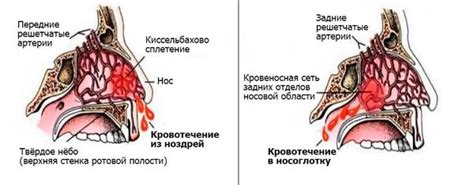 Основные симптомы носового кровотечения