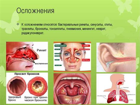 Острая респираторная вирусная инфекция