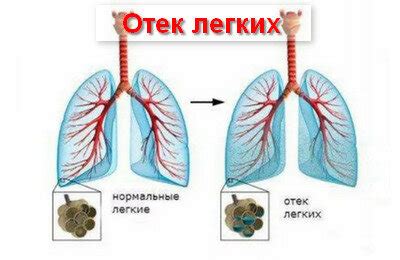 Отек легких и его последствия