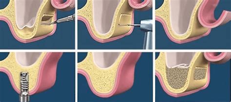 Открытый синус лифтинг в стоматологии