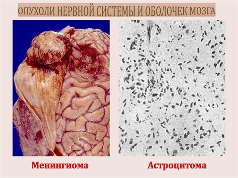 Отличие доброкачественных и злокачественных опухолей на рентгеновском снимке головы