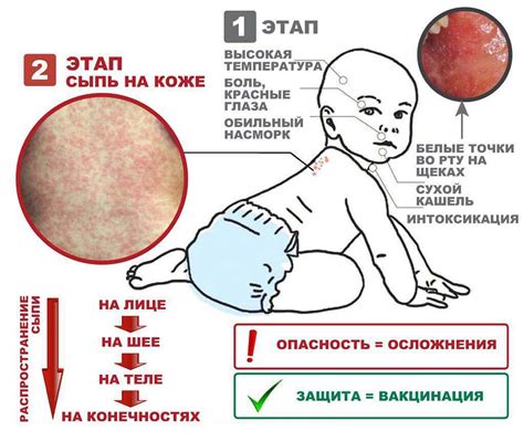 Отличия между корью и ветрянкой