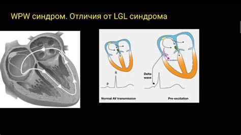 Отличия феномена от синдрома WPW