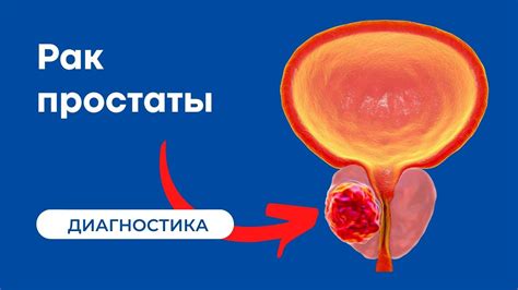 ПСА 10 как показатель рака предстательной железы