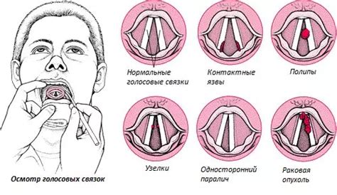 Паралич голосовых связок