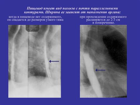 Патологии пищевода