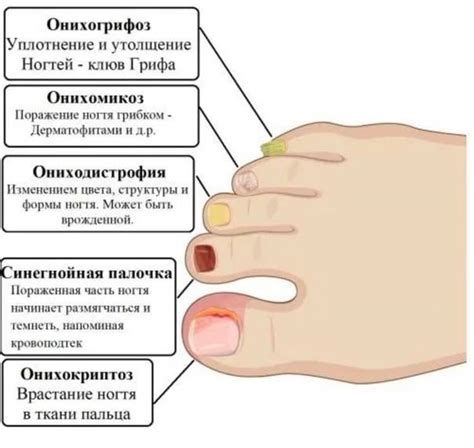 Первая помощь при падении ногтя на ноге