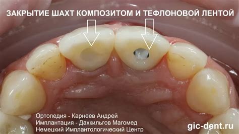 Питание после установки постоянных коронок