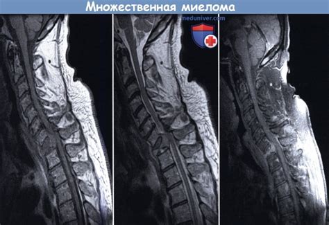 Плазмоцитома позвоночника