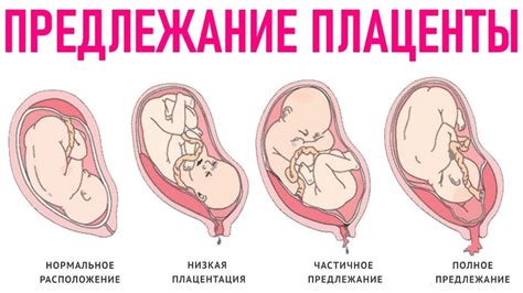 Плацента во время беременности