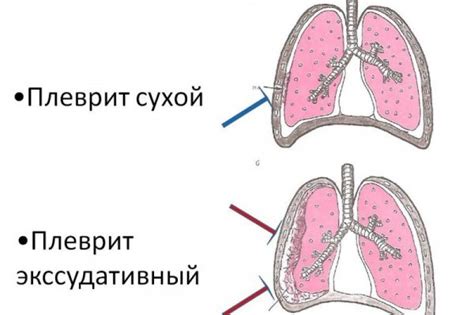 Плеврит