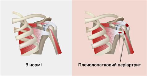 Плечелопаточный периартрит: как отличить от других причин боли