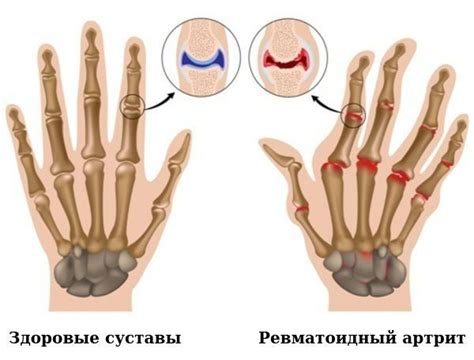 Повреждение тканей и суставов