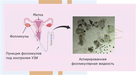 Повреждение фолликулов при удалении