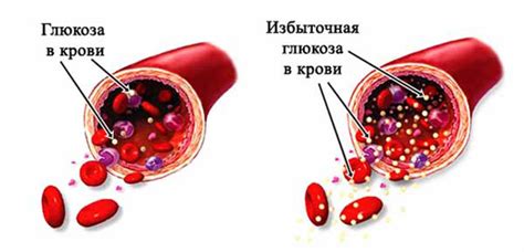 Повышение глюкозы