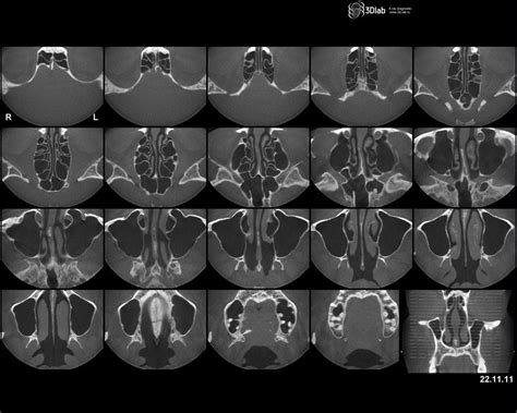 Познавательное описание КТ носа и околоносовых пазух