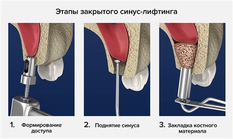 Показания для открытого синус лифтинга