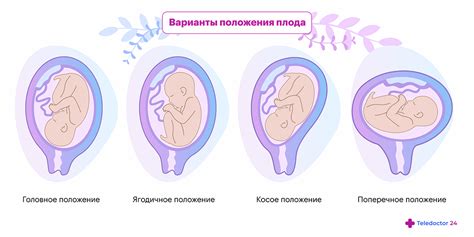 Положение головки плода при опускании: норма и отклонения