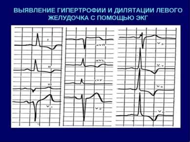 Последствия дилатации полости левого желудочка