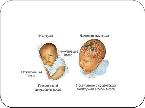 Последствия и профилактика желтушки у новорожденных