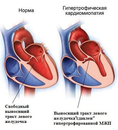 Последствия увеличения массы миокарда левого желудочка