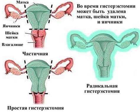 Последствия удаления матки при миоме