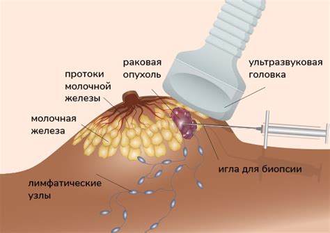 Пострадавшая молочная железа