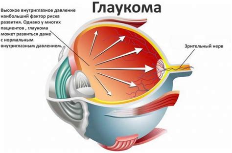 Почему возникает двоение в глазах утром?