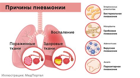 Почему у пневмонии меняется температура: причины и механизмы