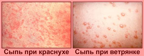 Почему у ребенка появляется сыпь при повышенной температуре?