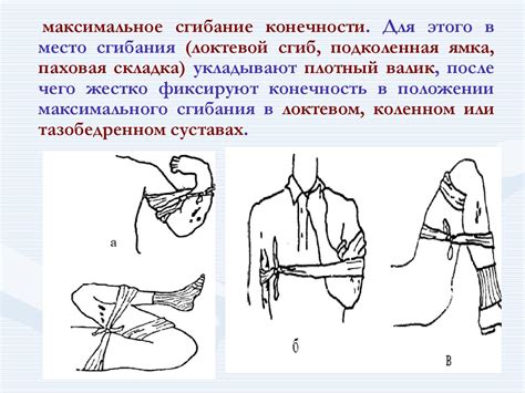 Правила накладывания кровоостанавливающего жгута