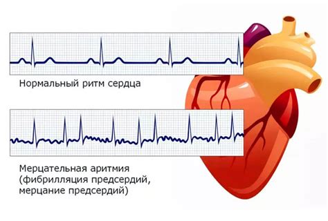 Предсердный ритм: какие могут быть причины?