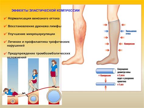 Преимущества эластической компрессии