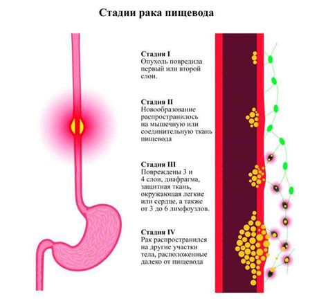 Признаки воспаления слизистой оболочки пищевода