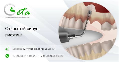 Применение синус лифтинга в стоматологии