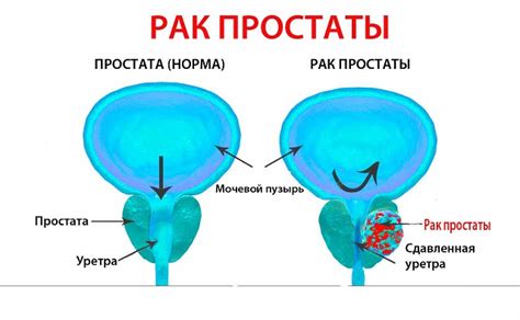 Причины возникновения карциномы предстательной железы