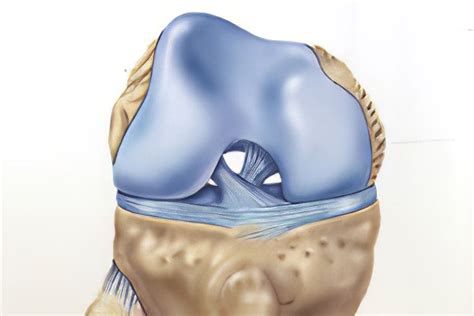 Причины возникновения менисцита медиального мениска коленного сустава
