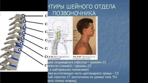 Причины и симптомы выпирающего позвонка на шее