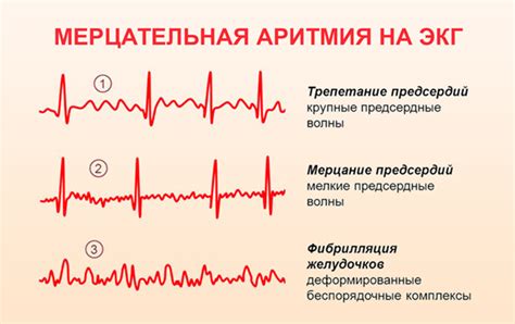 Причины и симптомы мерцательной аритмии