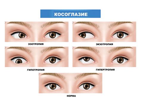 Причины одностороннего косоглазия