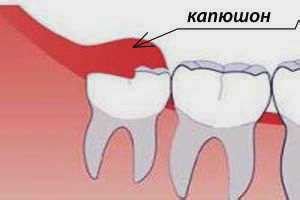 Причины отсутствия кровотечения при росте зуба мудрости