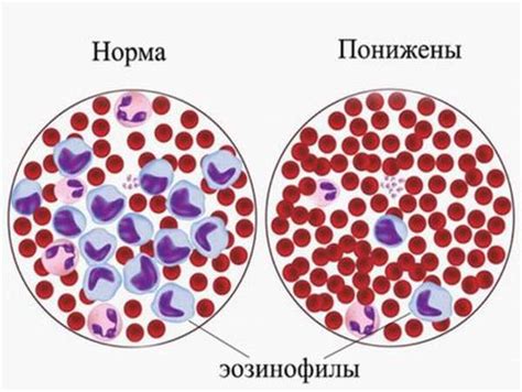 Причины повышения метамиелоцитов