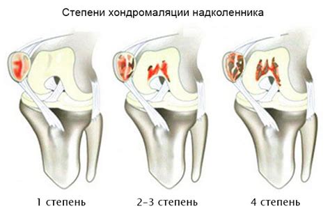 Причины развития хондромаляции надколенника 4 степени