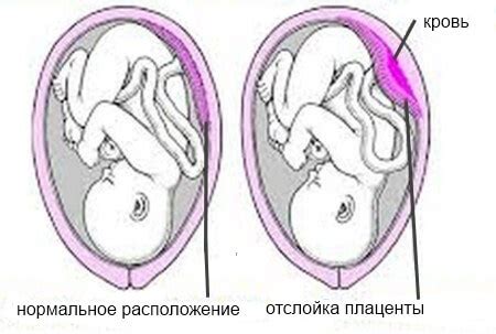 Проблемы с функцией плаценты