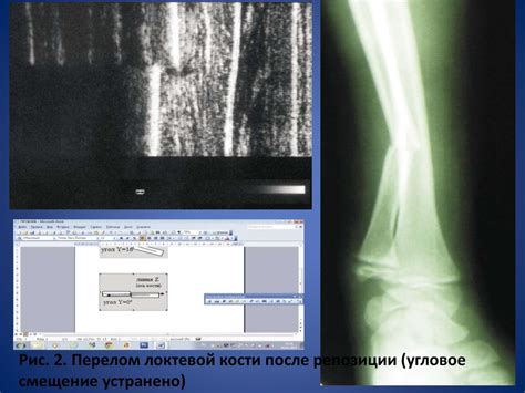 Проведение рентгеновских исследований трубчатых костей у новорожденных