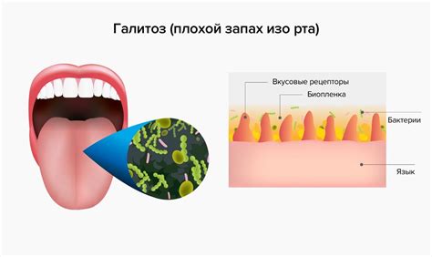 Провоцирующие факторы, влияющие на запах изо рта при отсутствии употребления алкоголя